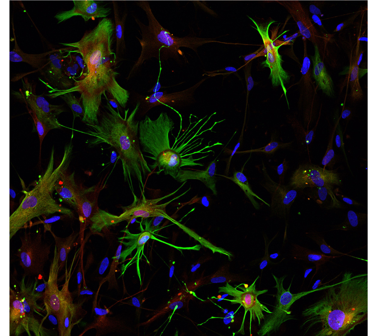 Defining the Role of Varicose Projection Astrocytes in Alzheimer's Disease Pathology